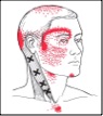 Trigger points in neck and pain pattern